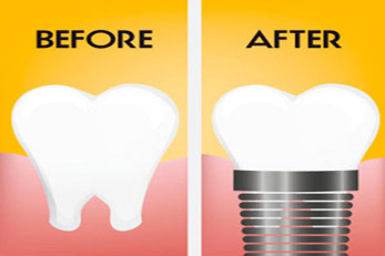 dental-implants