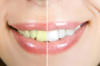 teeth-whitening